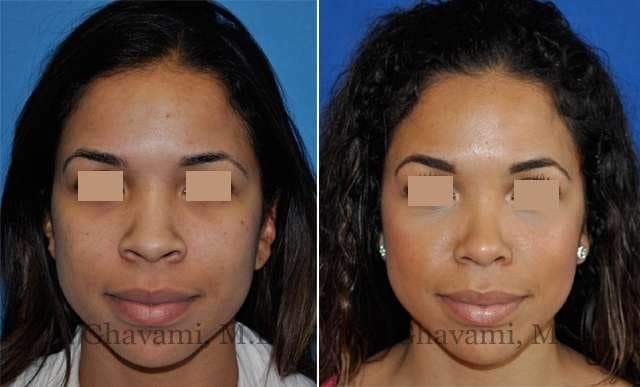 The Best Rhinoplasty Surgeons In Los Angeles - My Beauty Consultant