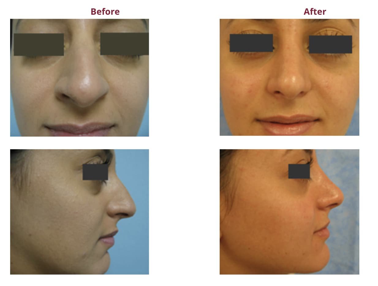 The Best Rhinoplasty Surgeons In Los Angeles - My Beauty Consultant